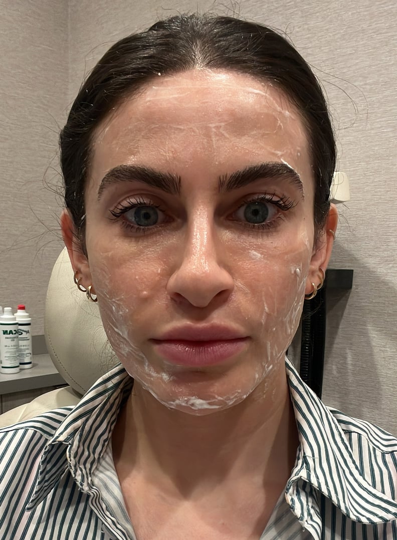 ultherapy before and after